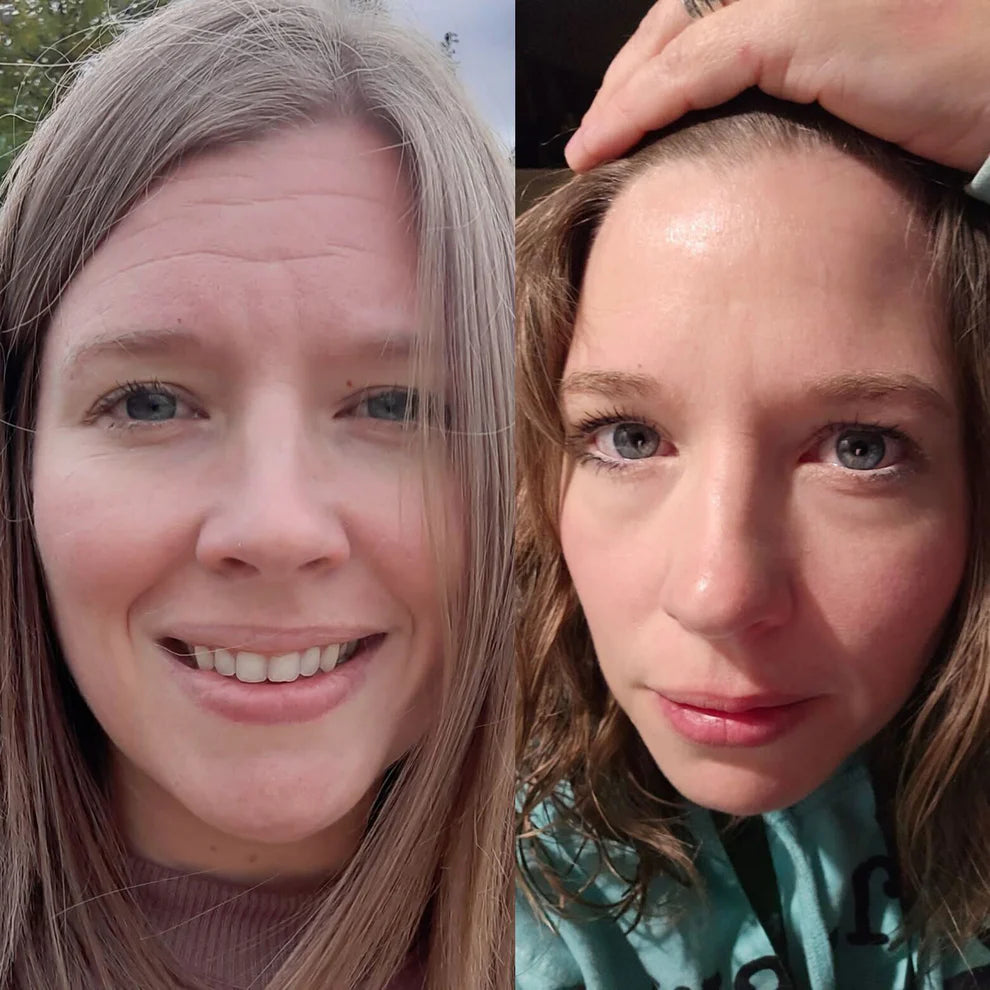 Renoveé™ – El Secreto para una Frente Lisa